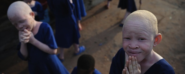 fueled-by-superstition-people-are-violently-attacking-albinos-in-tanzania-1409177333
